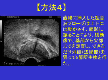 前立腺針生検