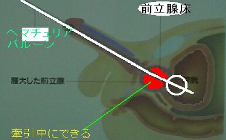 前立腺を内視鏡で切除
