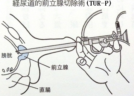 前立腺を内視鏡で切除