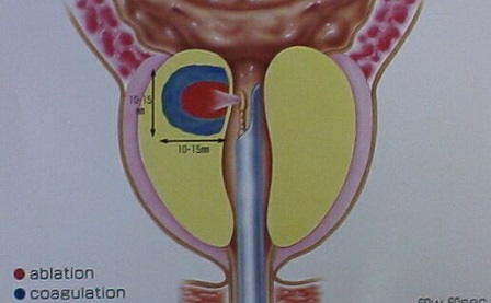 前立腺をVLAP