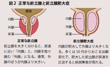 内側に肥大症