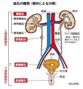 尿管結石